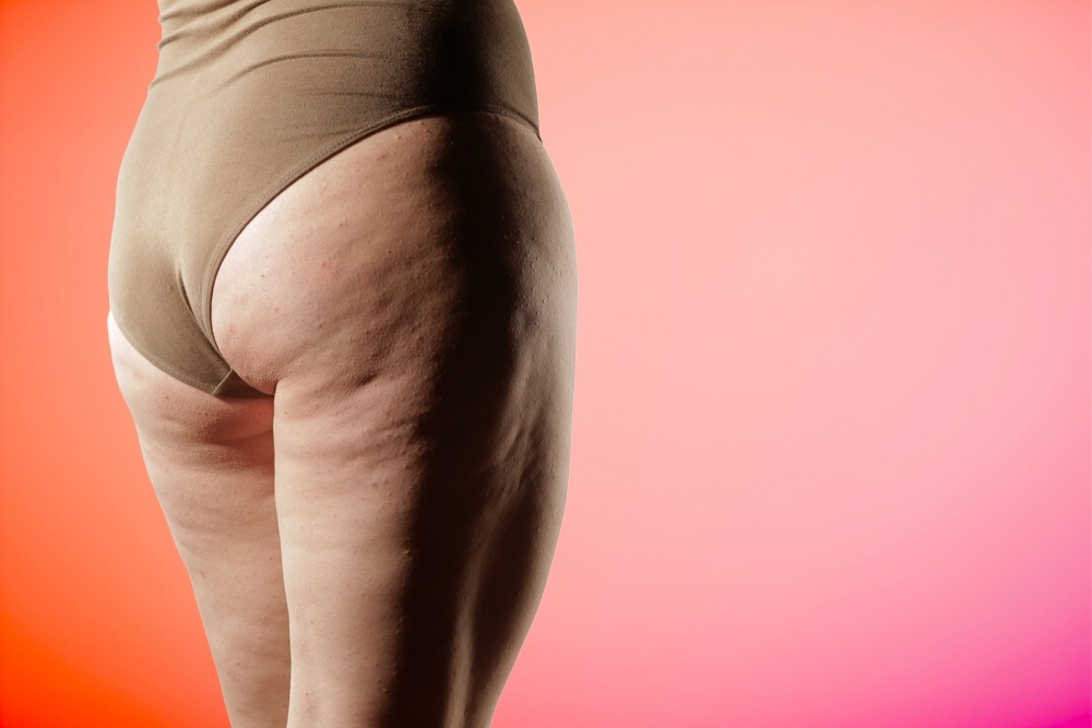 Cellulite Reduction In lincoln