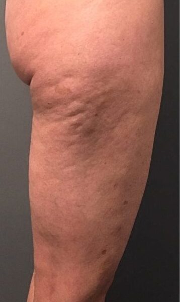 Cellulite Reduction In lincoln