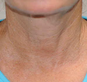 Bespoke skin tightening - after