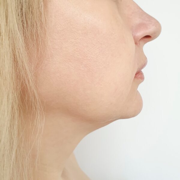 6 Week Course of Chin Sculpting & Tightening