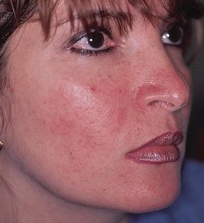 rosacea facial after