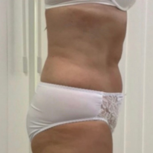 Fat Reduction Body Lipo